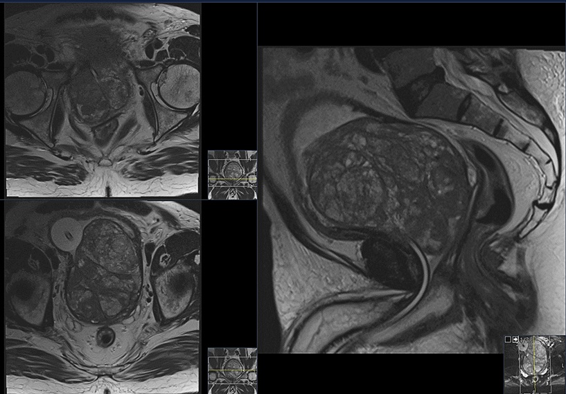 MRI μεγάλου προστάτη κατάλληλου για HoLEP